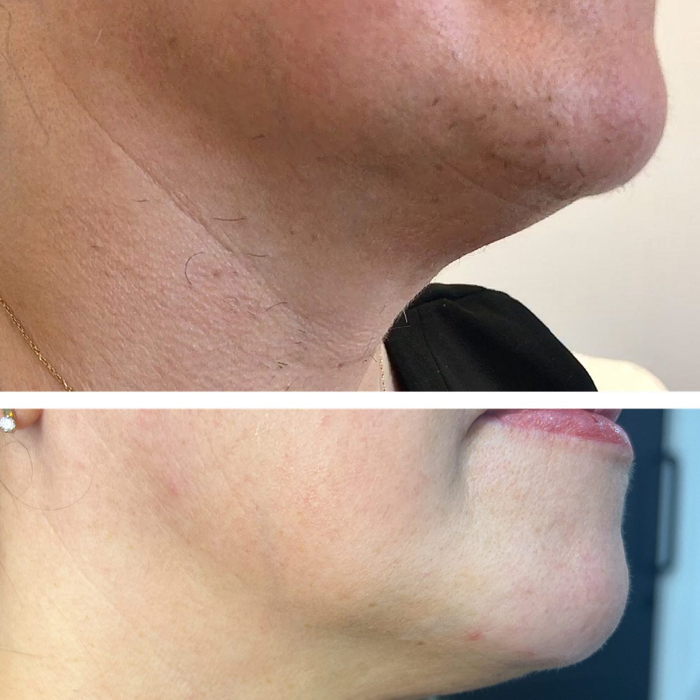 alt="Chin area with visible hair before laser hair removal treatment in Newcastle"